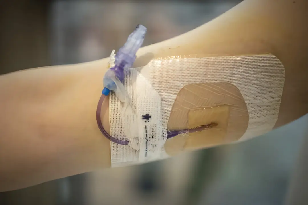 کانیولای تزریق (Cannula) متصل به لوله در دست بیمار برای درمان